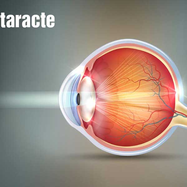 La Chirurgie de la Cataracte et du Cristallin