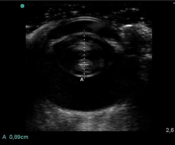 Echographie Oculaire